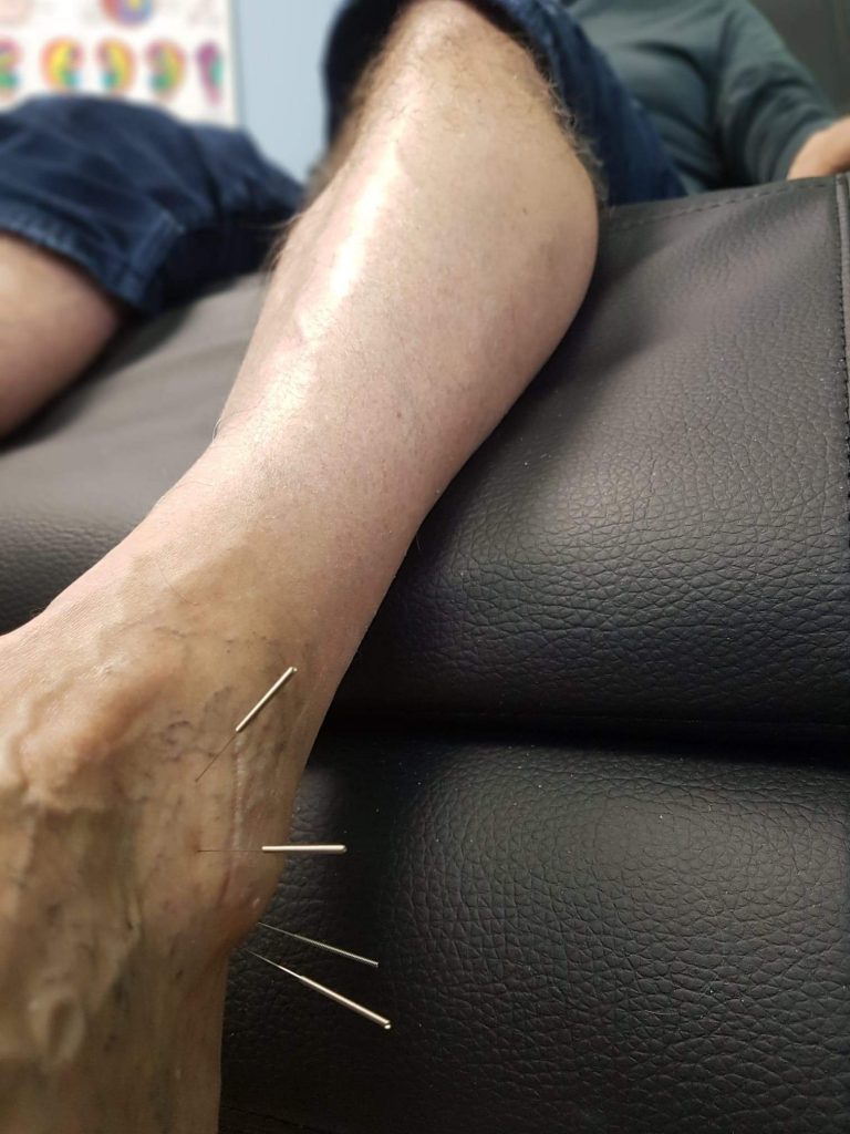 Man from Bedford getting an Acupuncture treatment for hip pain at Access Acupuncture