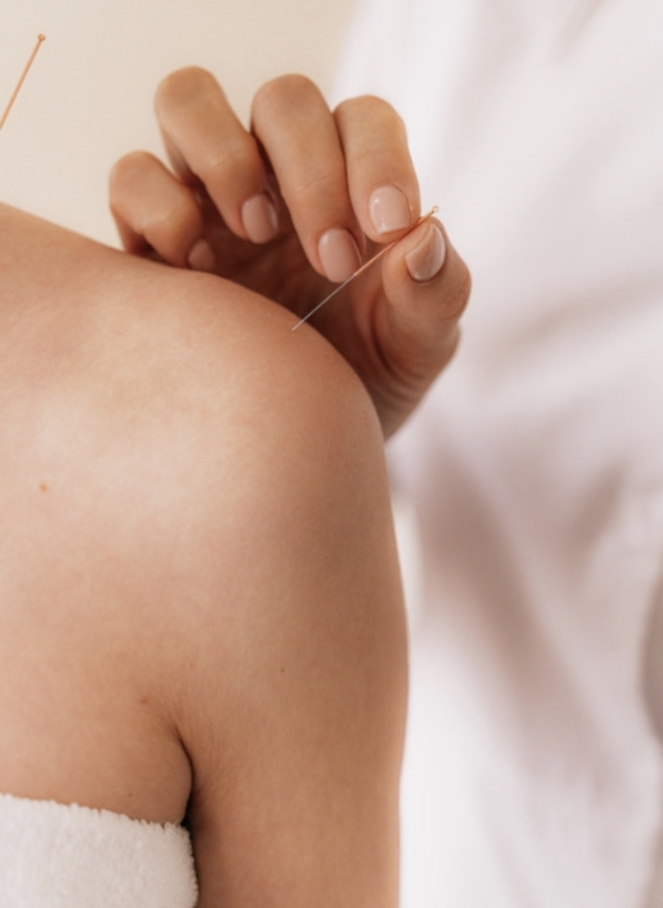 What is the difference between Dry Needling & Acupuncture? ACCESS ACUPUNCTURE