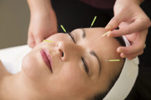Cosmetic acupuncture for facial rejuvenation
